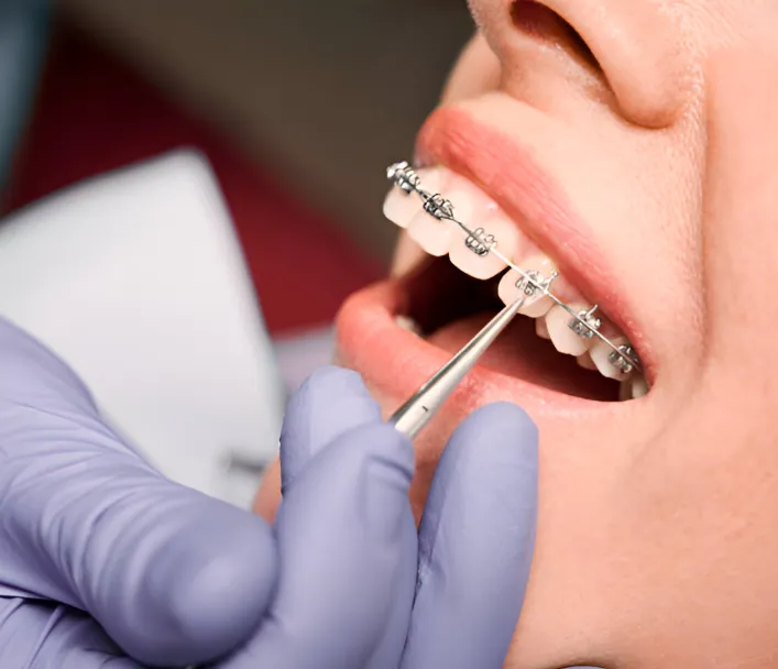 How to Choose the Right Orthodontic Treatment for Your Smile